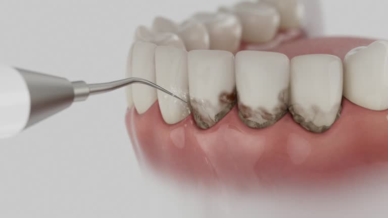 Trusted Wisdom Tooth Removal service in Worthington, OH - Dentist Open Now